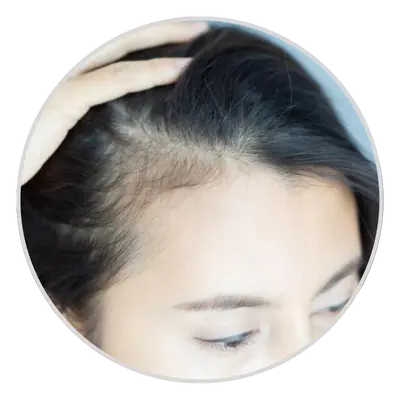 Receding Hairline
