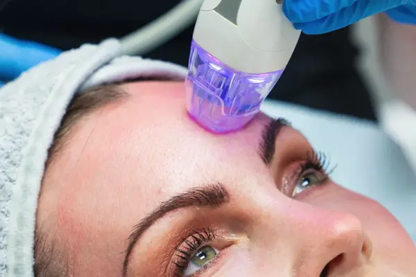 MICRONEEDLING-RADIOFREQUENCY