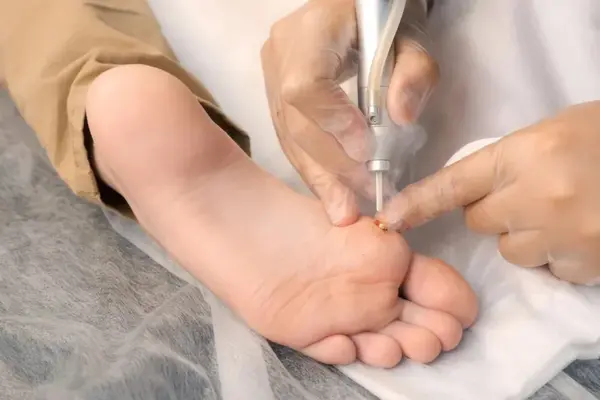 skin-warts-removal-by-laser