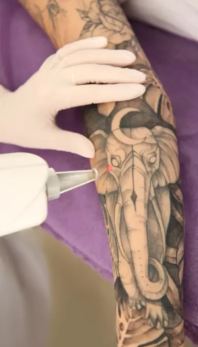 tattoo-removal-treatment-process
