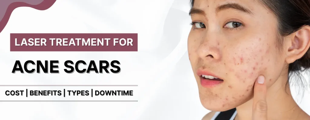 Laser Treatment for Acne Scars Cost in Pune