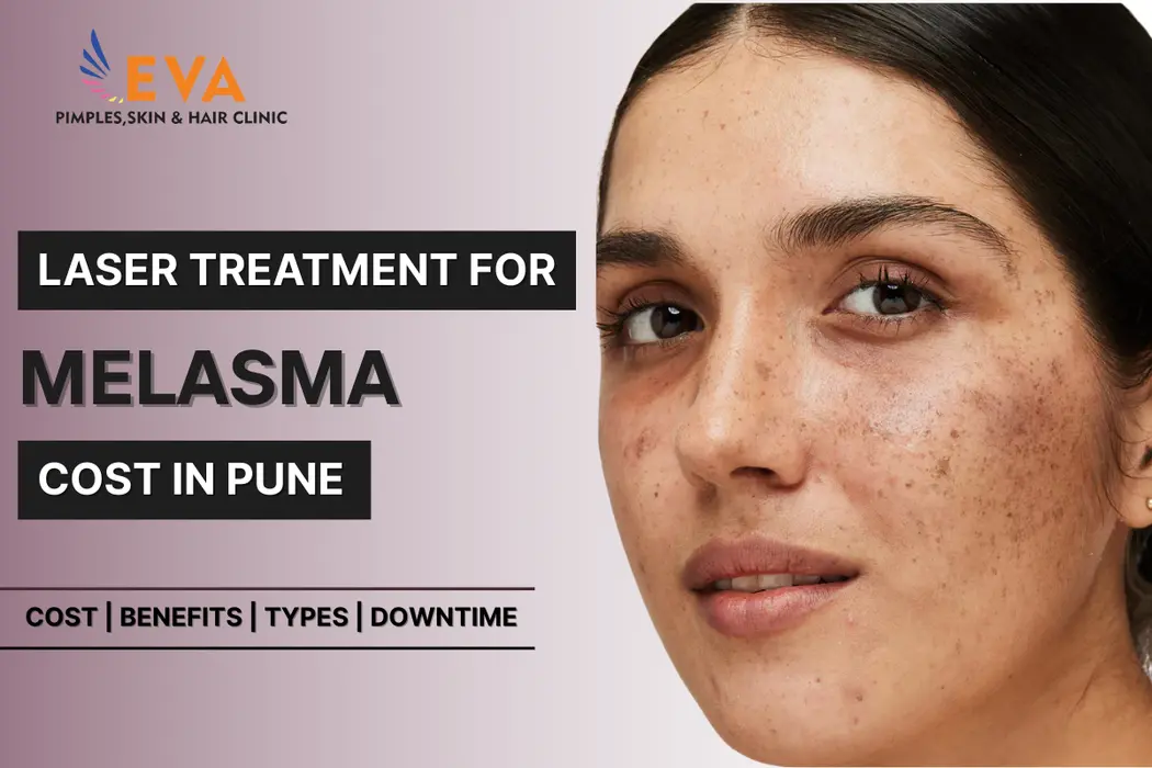 Melasma laser Treatment cost in Pune