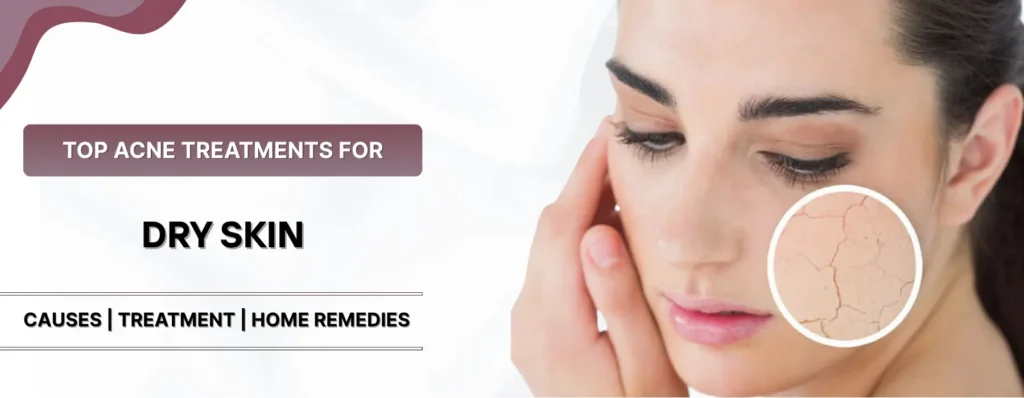 Acne Treatments for Dry Skin