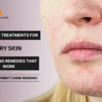 Best Acne Treatments for Dry Skin