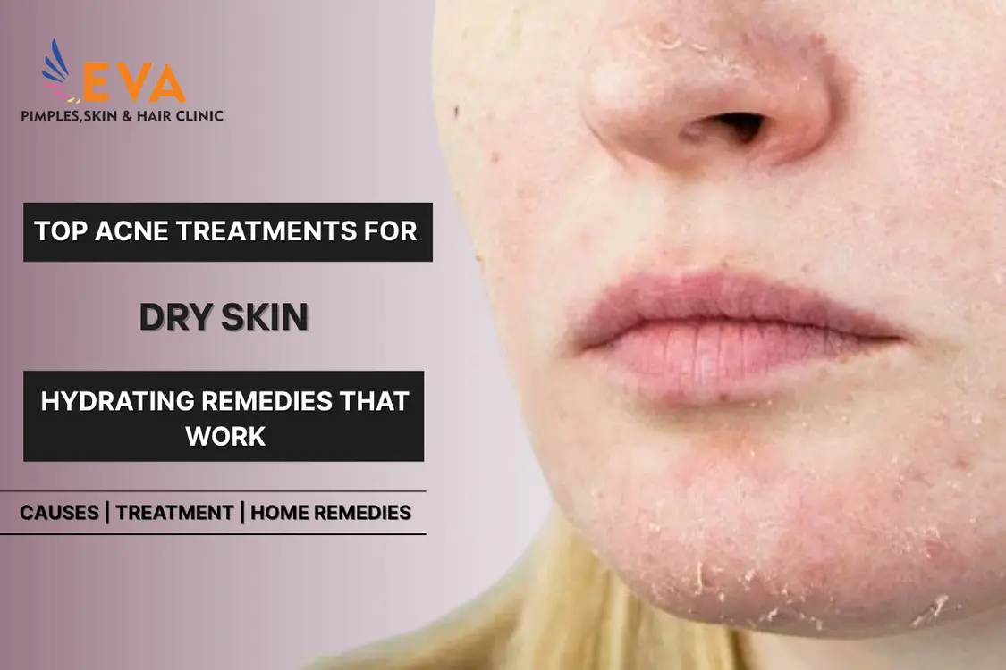 Best Acne Treatments for Dry Skin
