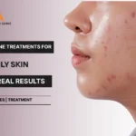 Best Acne Treatments for Oily Skin