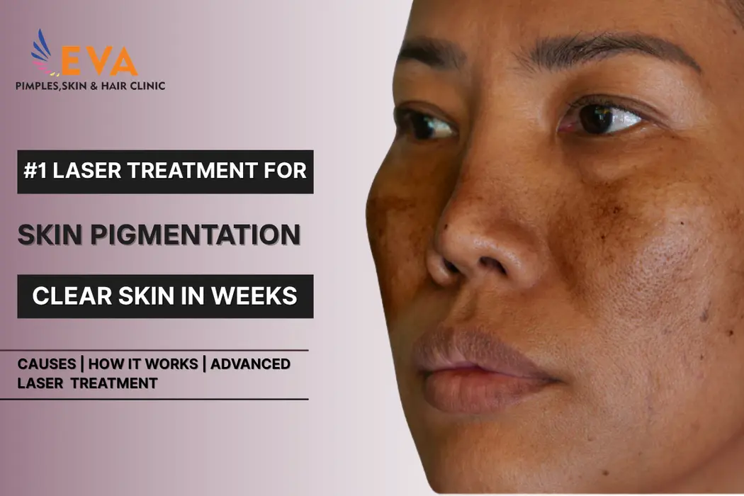 Best Laser Treatment for Skin Pigmentation