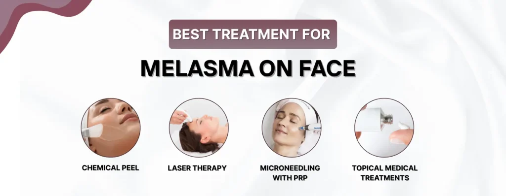 Best Treatment for Melasma on Face