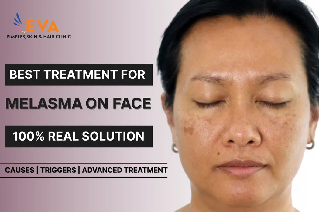Best Treatment for Melasma