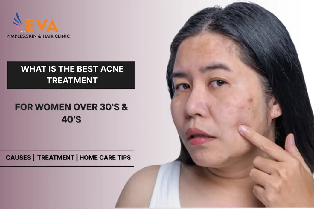Acne Treatment for Women