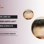 Hair Transplants lifspan