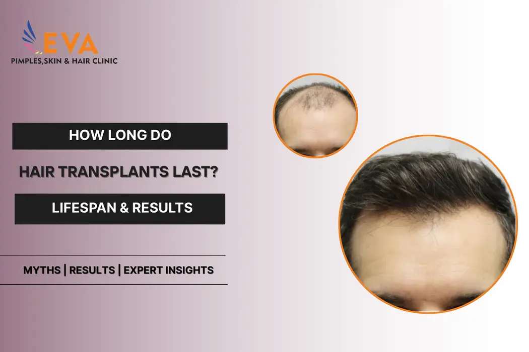 Hair Transplants lifspan