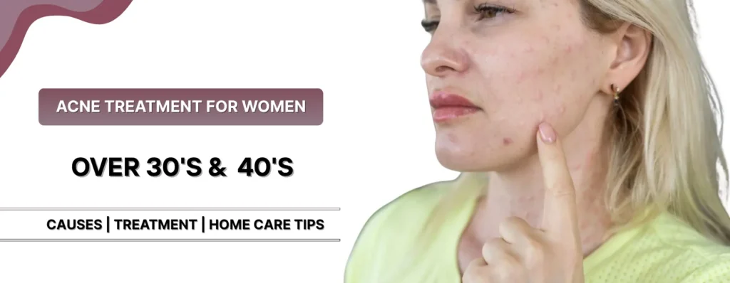 What is the Best Acne Treatment for Women