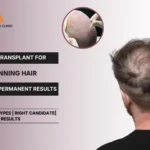 Hair Transplant Treatment for Thinning Hair