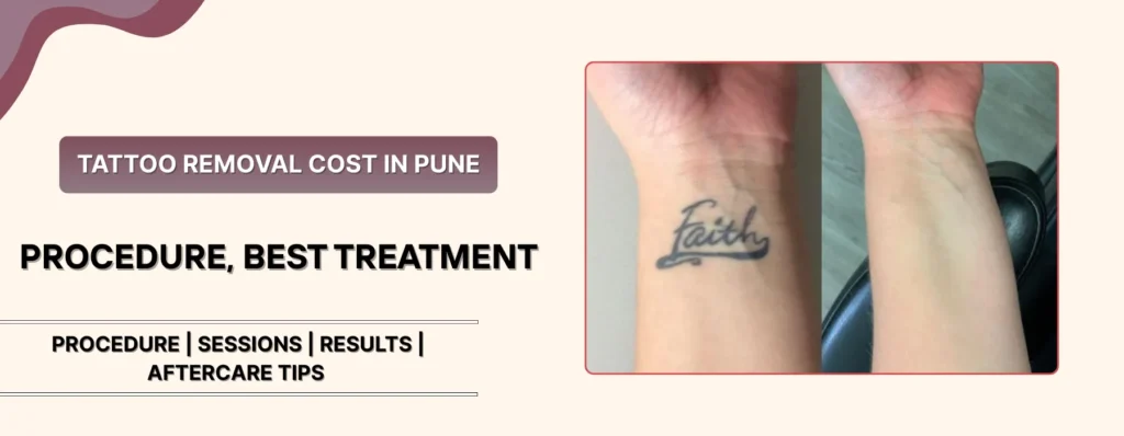 Tattoo Removal Cost in Pune