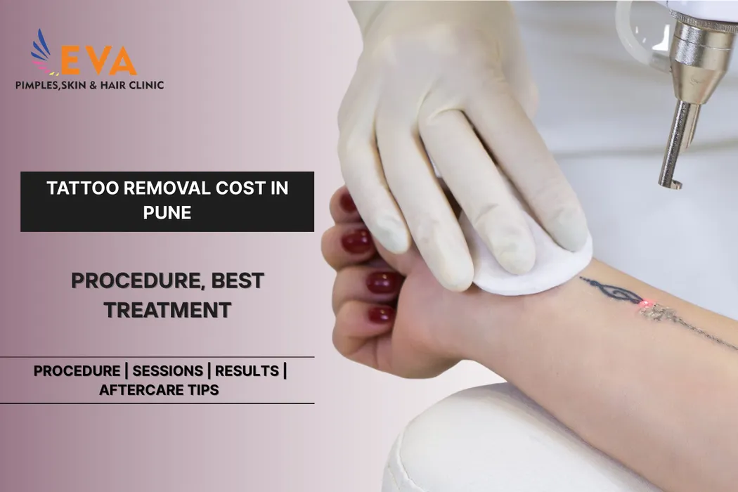Tattoo Removal Cost