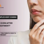 acne-recurrence-after-treatment