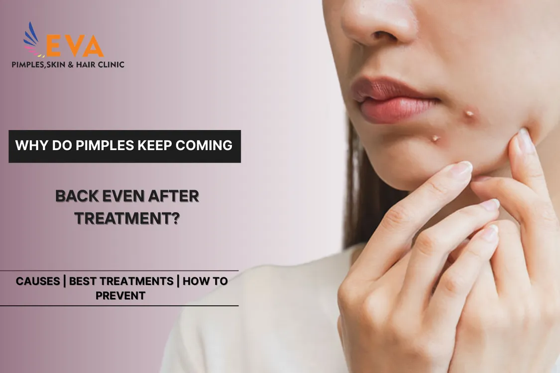 acne-recurrence-after-treatment