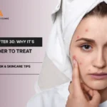 Acne After 30 Why It’s Harder to Treat