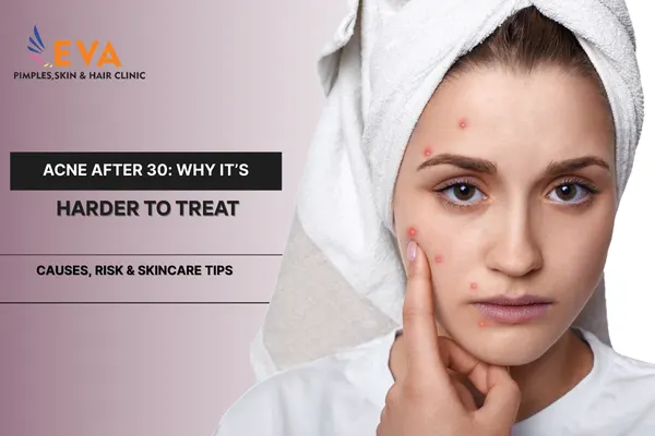 Acne After 30 Why It’s Harder to Treat