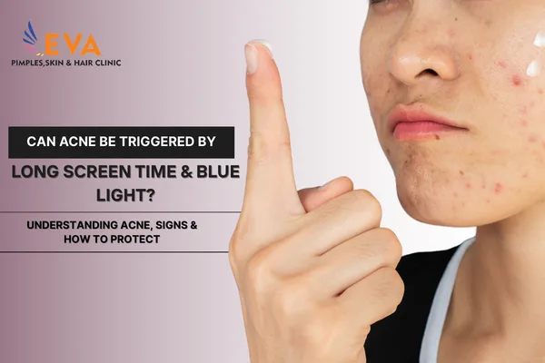 Can Acne Be Triggered by Long Screen Time & Blue Light