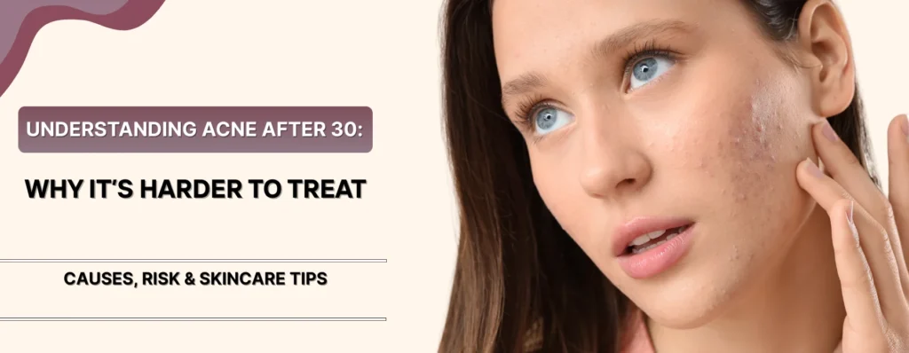 Acne After 30: Why It’s Harder to Treat