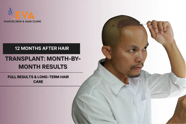 12 Months After Hair Transplant