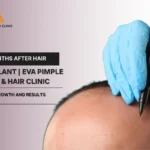 4 Months After Hair Transplant