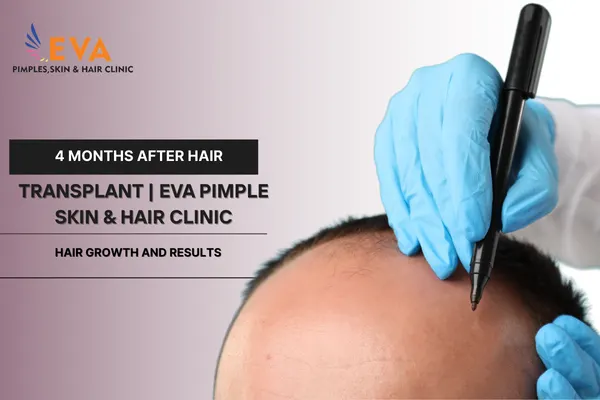 4 Months After Hair Transplant