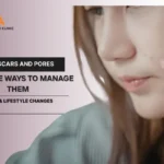 Acne Scars and Pores