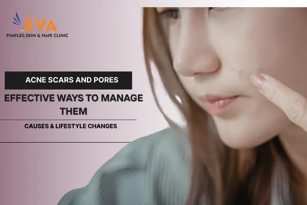 Acne Scars and Pores