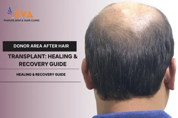 Donor Area After Hair Transplant
