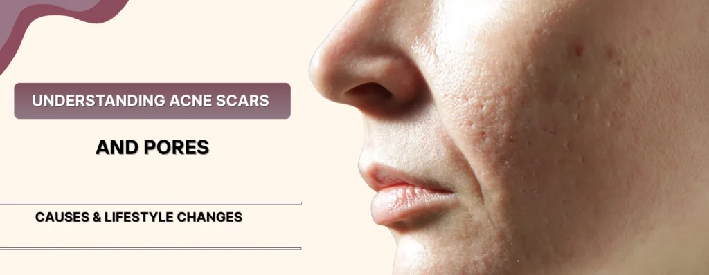 Acne Scars and Pores
