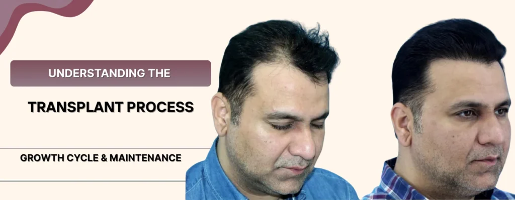Hair Transplant Maintenance