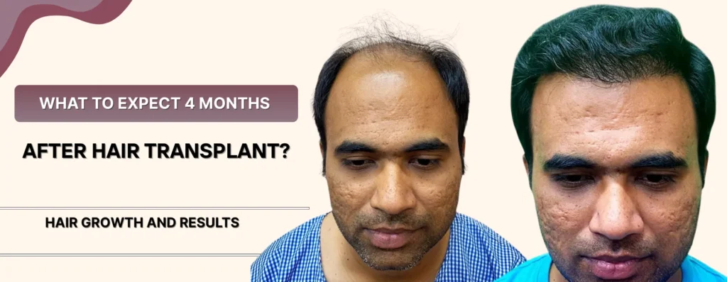 4 Months After Hair Transplant
