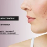 acne breakouts during summer