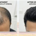 Battling Pune's Hard Water Advanced Hair Loss Treatments That Actually Work