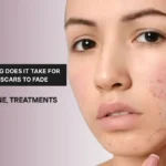 Best Treatments for Acne Scars