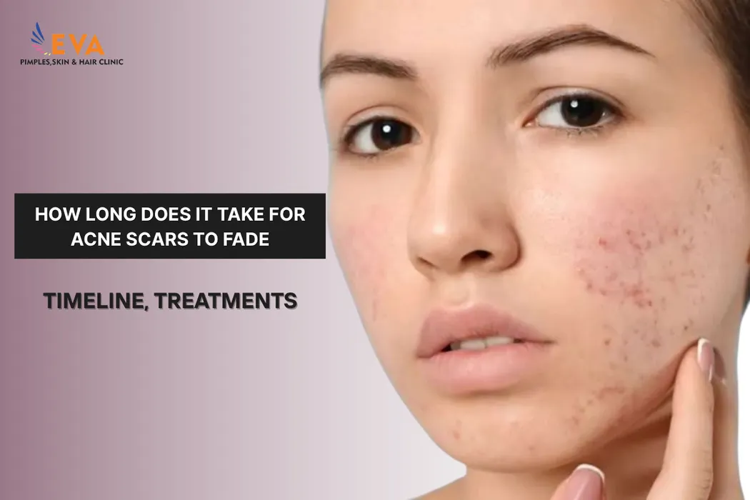 Best Treatments for Acne Scars