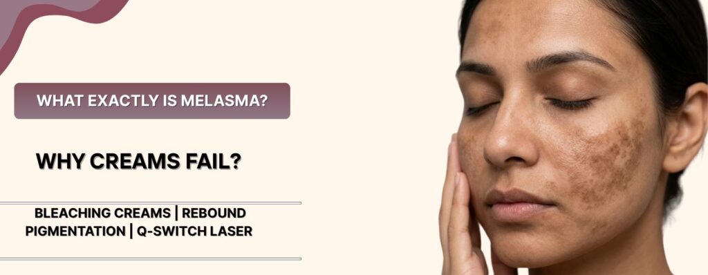 Key features in the blog for melasma treatment