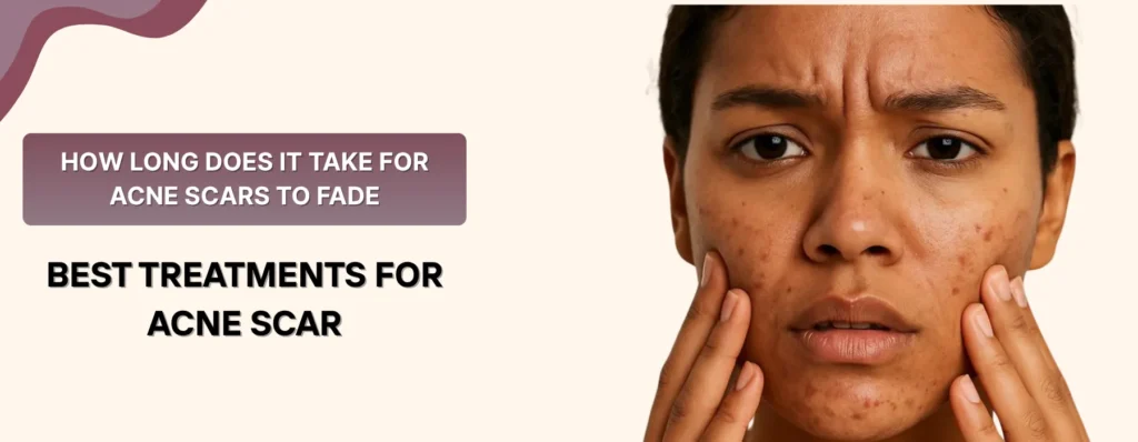 How long does it take for acne scars to fade​