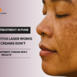 Melasma Treatment in Pune: Why Q-Switch Laser Works When Creams Don't
