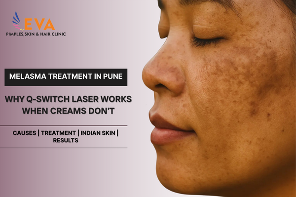 Melasma Treatment in Pune: Why Q-Switch Laser Works When Creams Don't