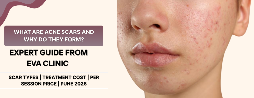 What Are Acne Scars Treatment Cost in Pune and Why Do They Form?