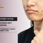 Frustrated with Sudden Breakouts? What Is the Most Effective Acne Treatment in Pune?