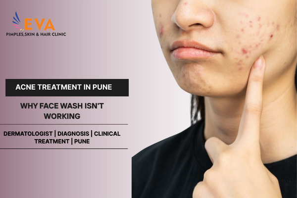 Frustrated with Sudden Breakouts? What Is the Most Effective Acne Treatment in Pune?
