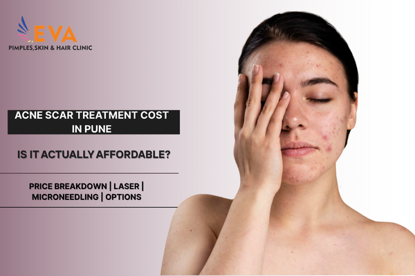 Close-up of face with visible acne scarring (texture/pitted scars clearly visible) — relatable to someone researching cost
