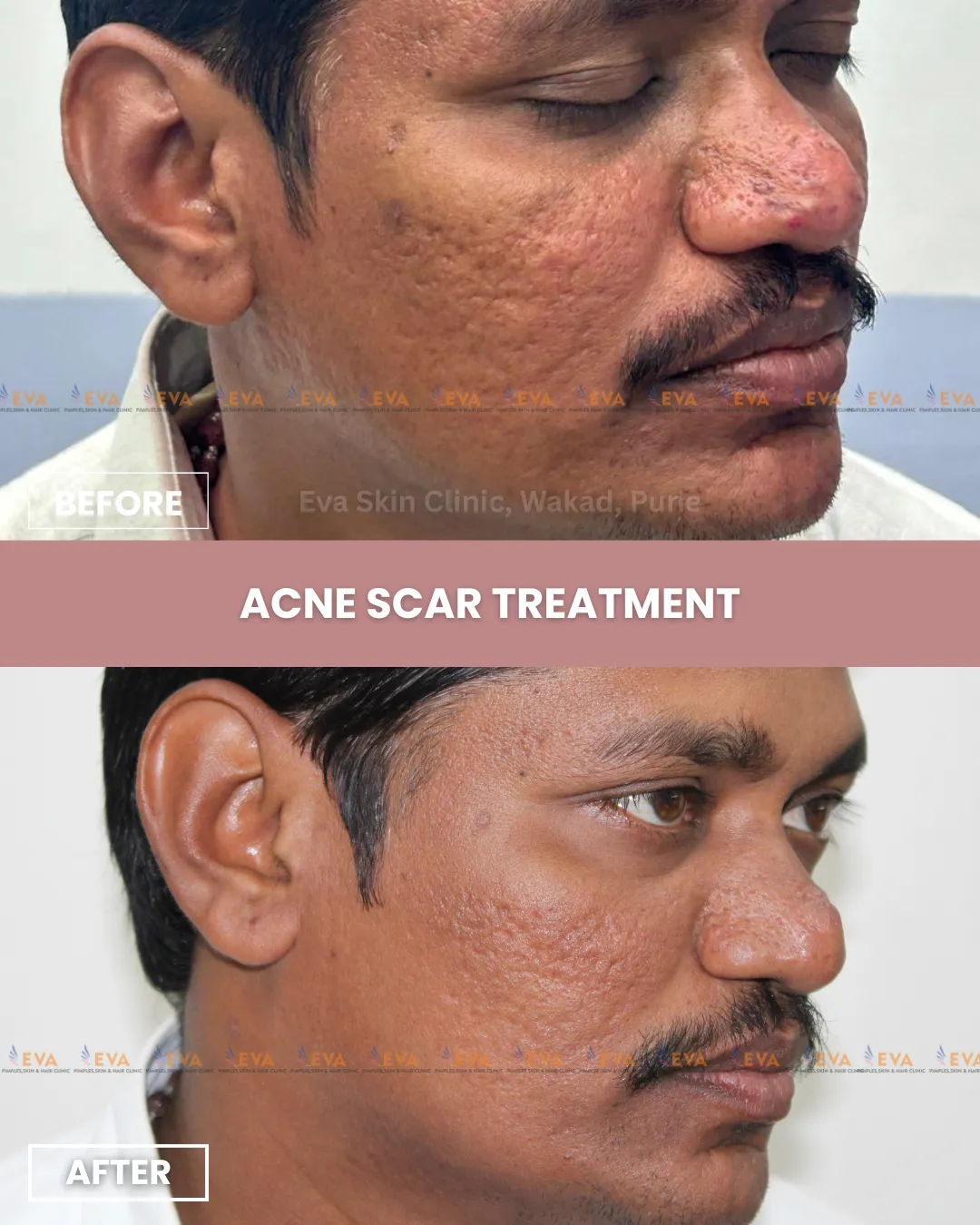 Acne Scar Treatment Wakad