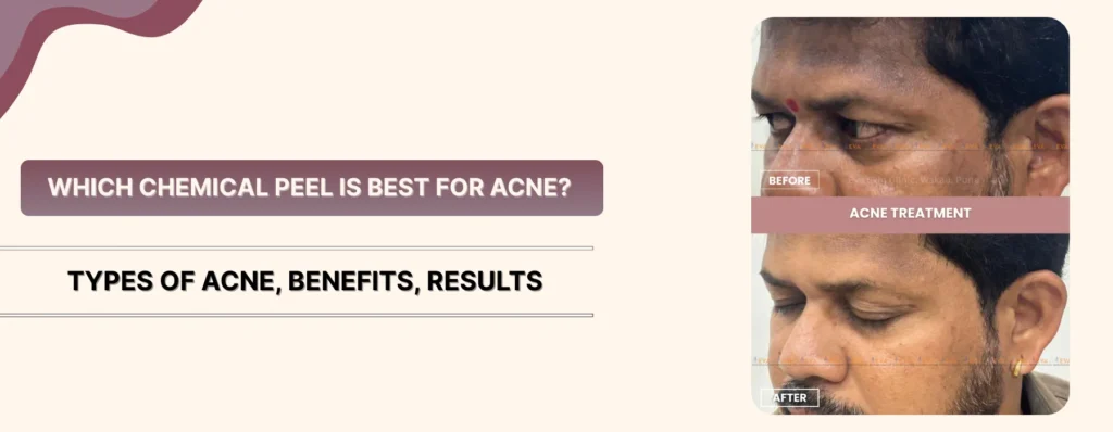 Chemical Peel Is Best for Acne