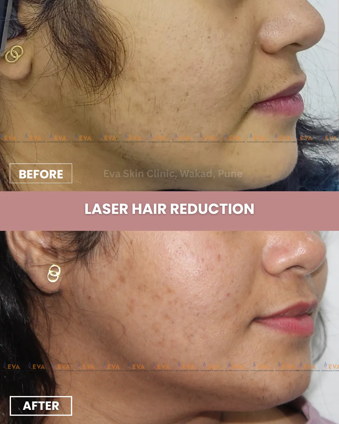 Laser hair reduction treatment results
